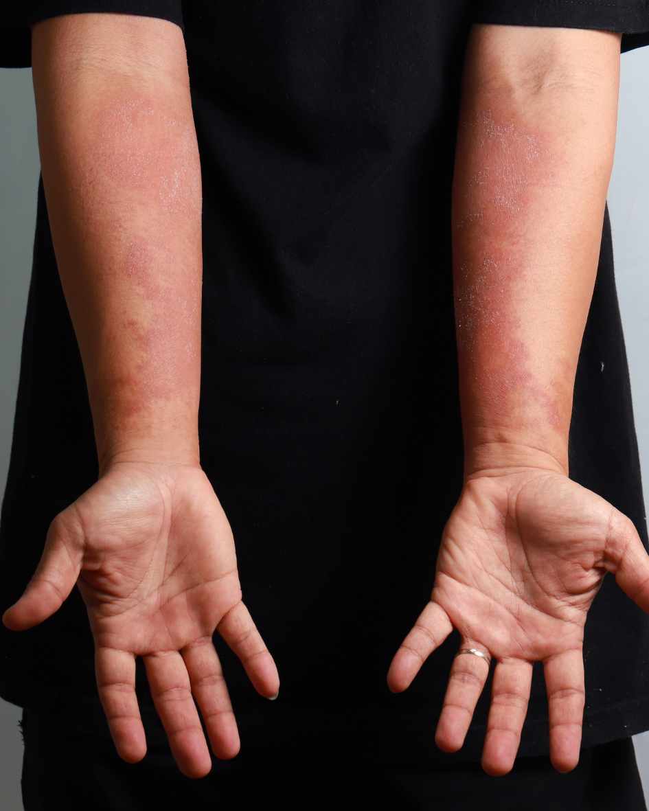 qu'est ce que l'eczema